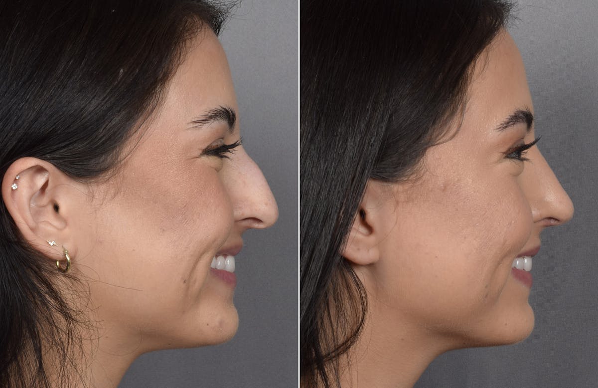 Rhinoplasty Before & After Gallery - Patient 368014 - Image 3