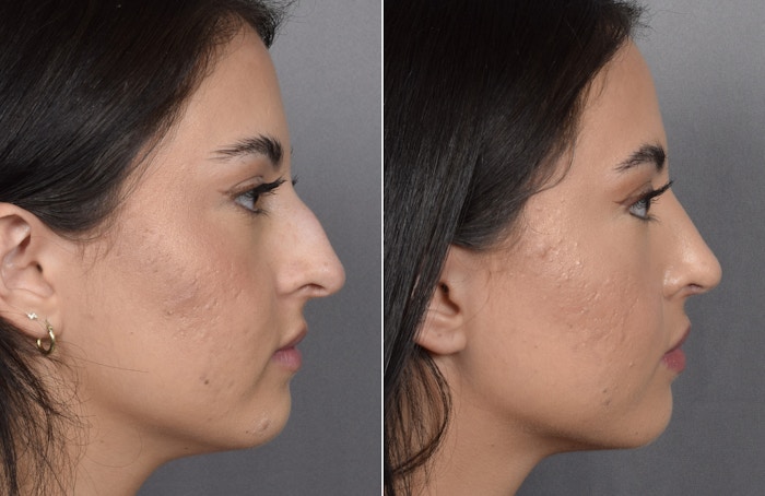Rhinoplasty Before & After Gallery - Patient 368014 - Image 1