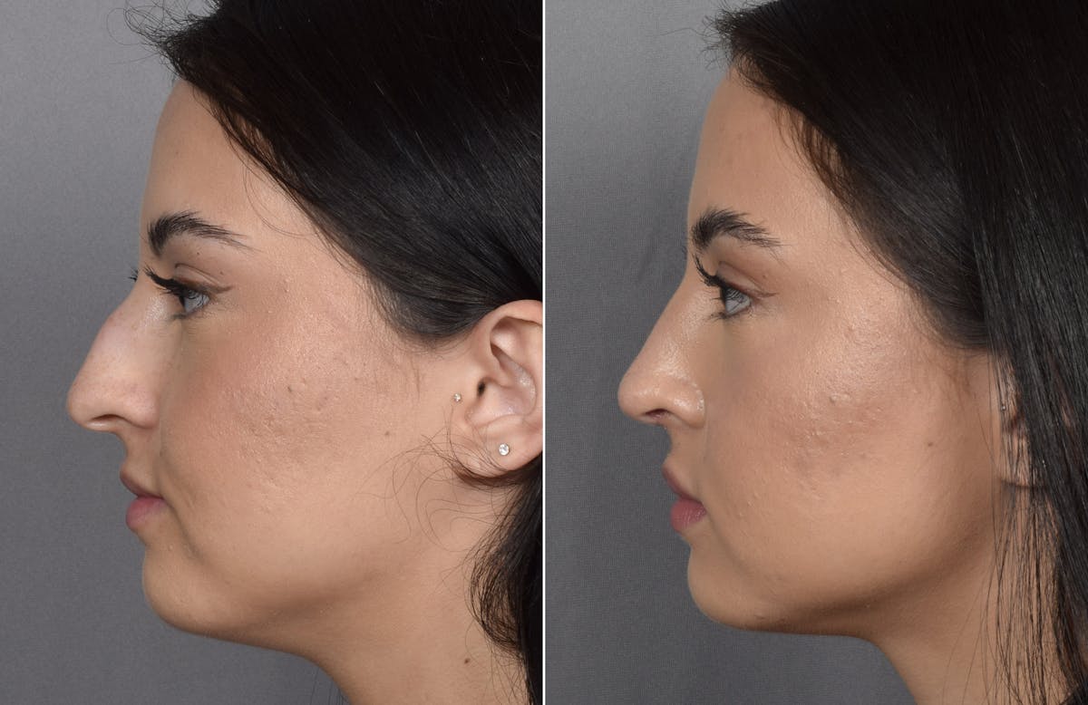 Rhinoplasty Before & After Gallery - Patient 368014 - Image 5