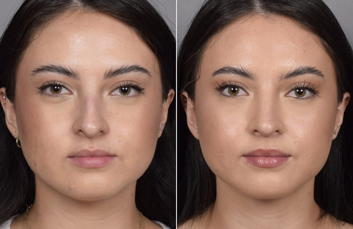 Rhinoplasty Before & After Gallery - Patient 368014 - Image 6