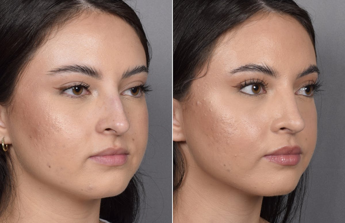 Rhinoplasty Before & After Gallery - Patient 368014 - Image 2