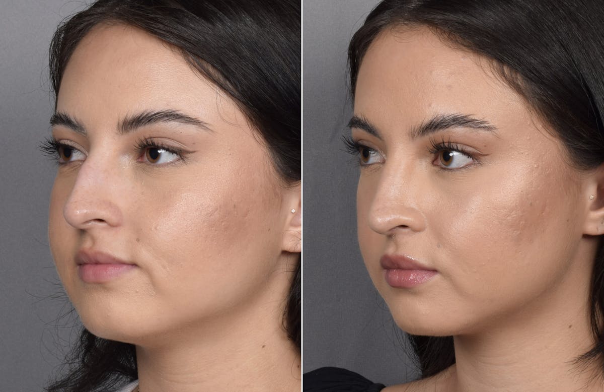 Rhinoplasty Before & After Gallery - Patient 368014 - Image 7