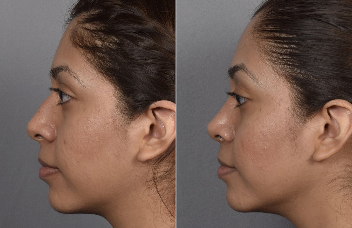 Rhinoplasty Before & After Gallery - Patient 315439 - Image 5
