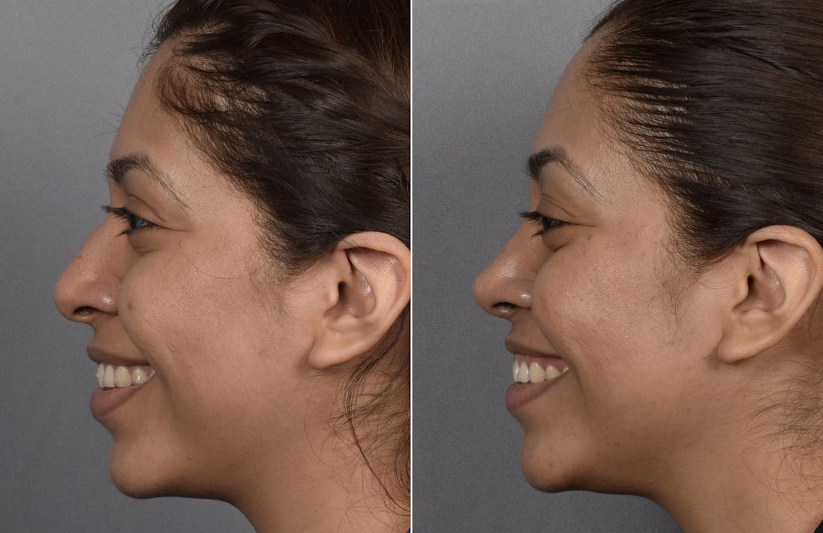Rhinoplasty Before & After Gallery - Patient 315439 - Image 3