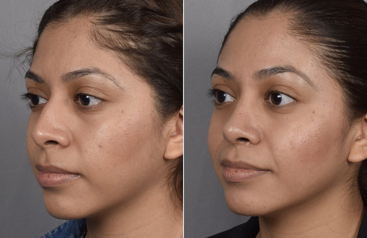 Rhinoplasty Before & After Gallery - Patient 315439 - Image 6