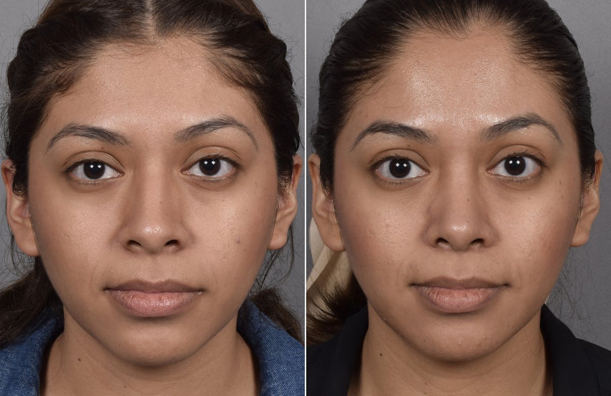 Rhinoplasty Before & After Gallery - Patient 315439 - Image 7