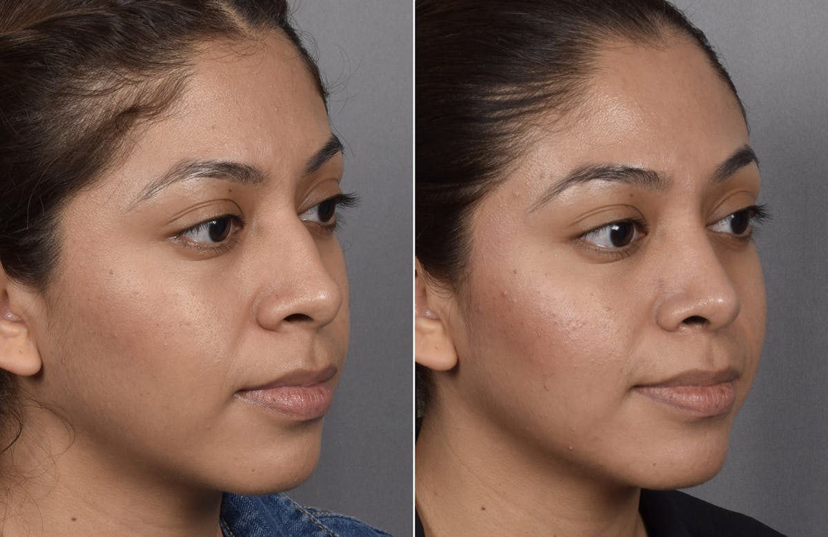 Rhinoplasty Before & After Gallery - Patient 315439 - Image 2