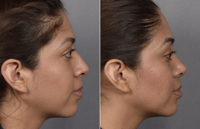 Rhinoplasty Before & After Gallery - Patient 315439 - Image 1