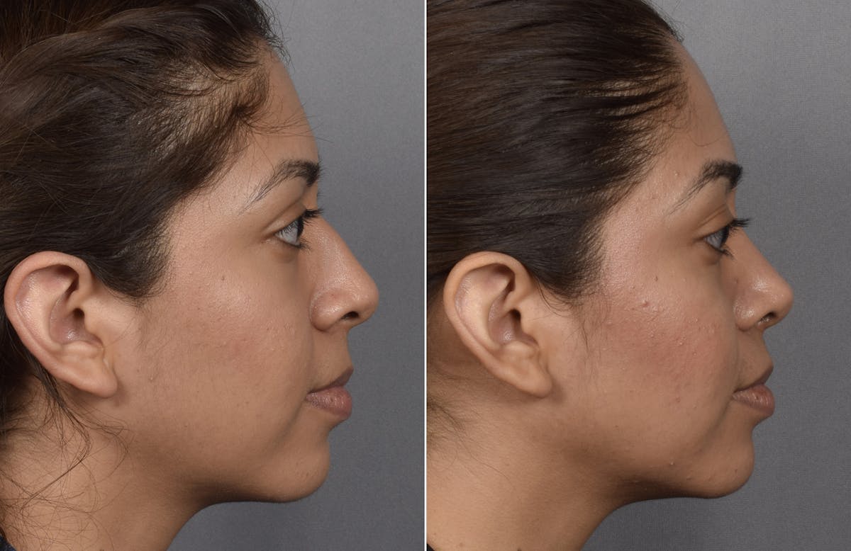 Rhinoplasty Before & After Gallery - Patient 315439 - Image 1