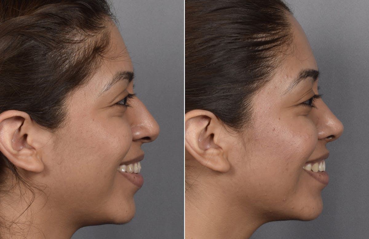 Rhinoplasty Before & After Gallery - Patient 315439 - Image 4