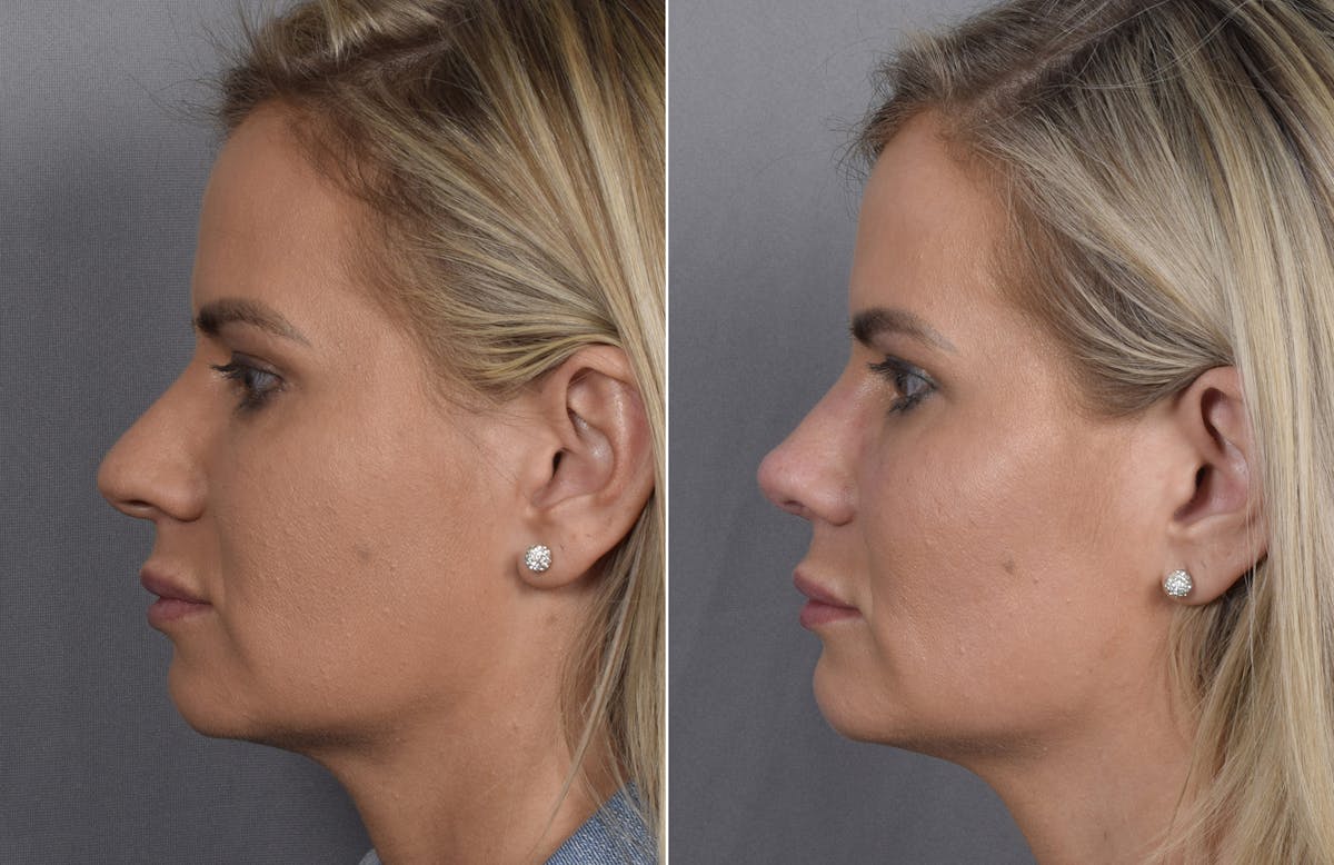 Rhinoplasty Before & After Gallery - Patient 236819 - Image 7