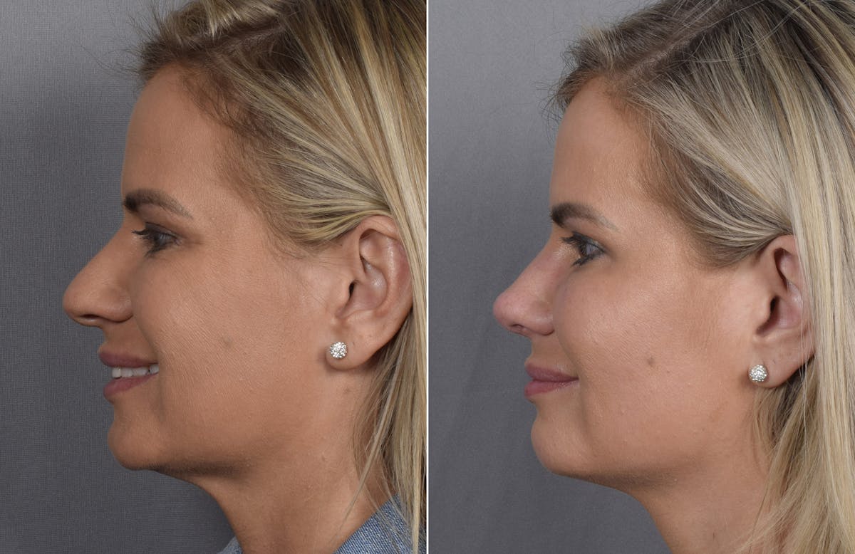 Rhinoplasty Before & After Gallery - Patient 236819 - Image 6