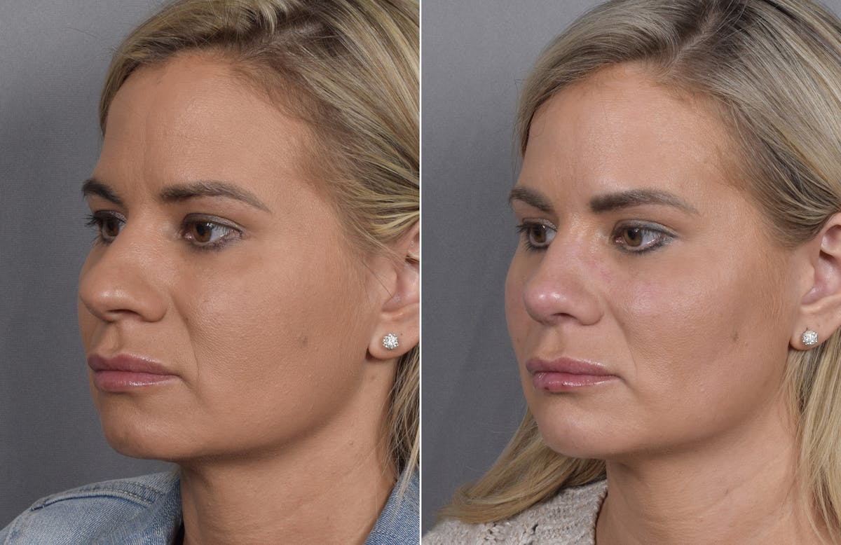 Rhinoplasty Before & After Gallery - Patient 236819 - Image 5
