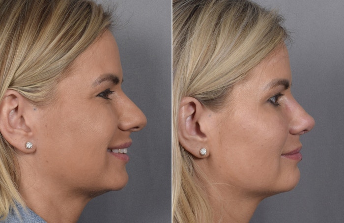 Rhinoplasty Before & After Gallery - Patient 236819 - Image 1