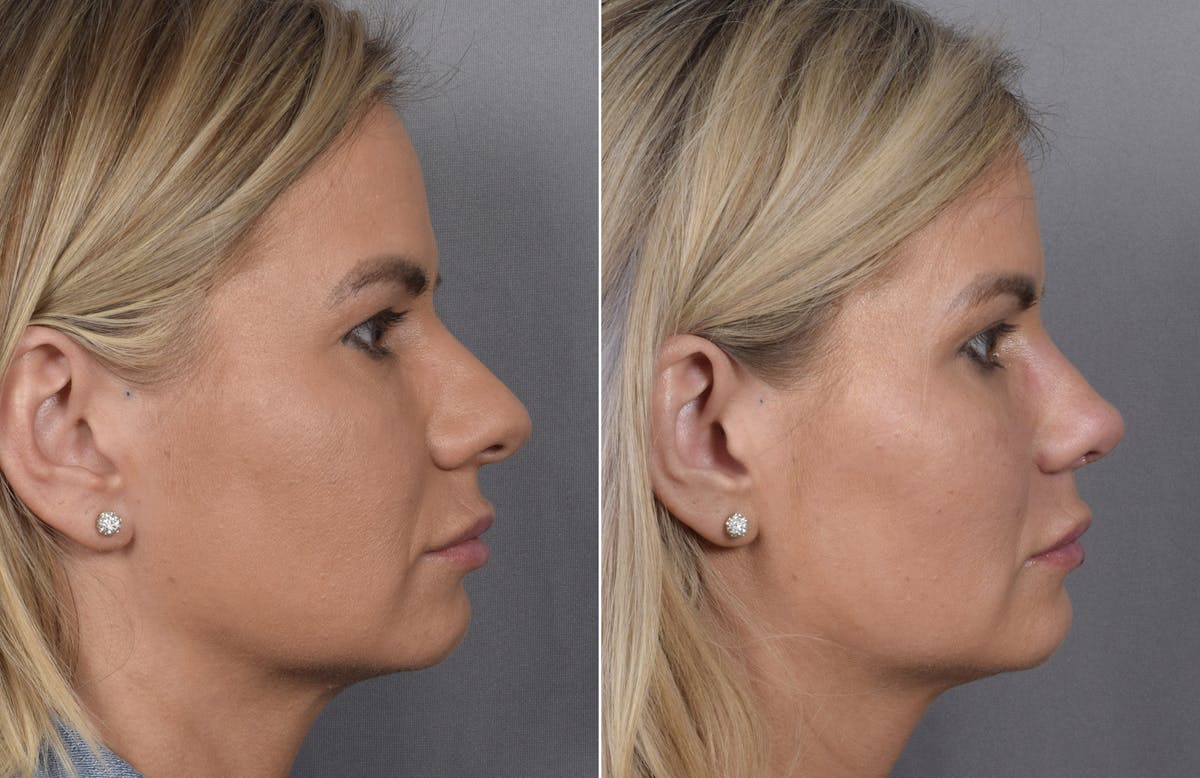 Rhinoplasty Before & After Gallery - Patient 236819 - Image 2