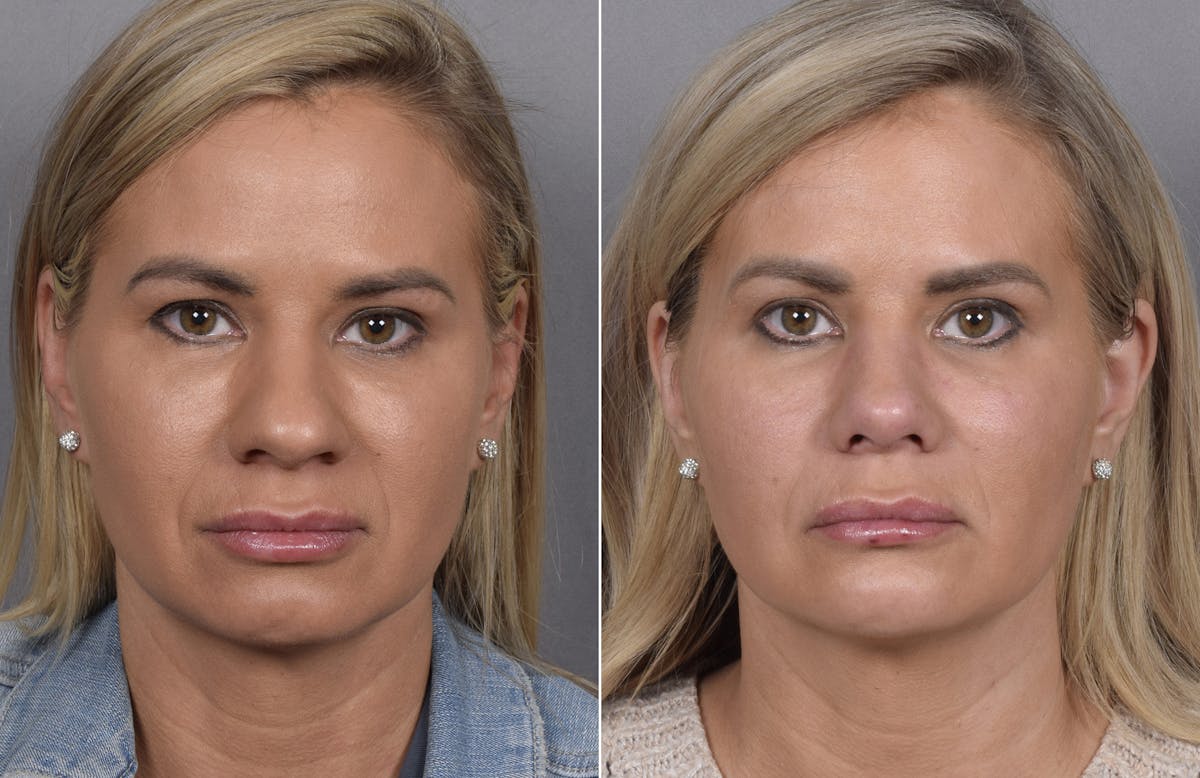 Rhinoplasty Before & After Gallery - Patient 236819 - Image 3