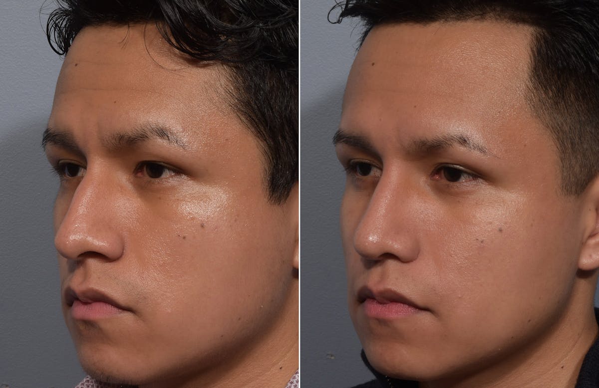 Rhinoplasty Before & After Gallery - Patient 315499 - Image 4