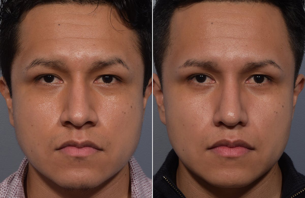 Rhinoplasty Before & After Gallery - Patient 315499 - Image 2