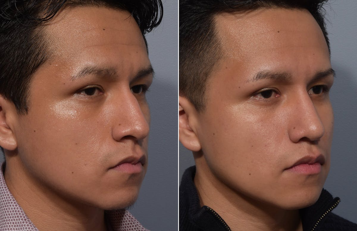 Rhinoplasty Before & After Gallery - Patient 315499 - Image 3