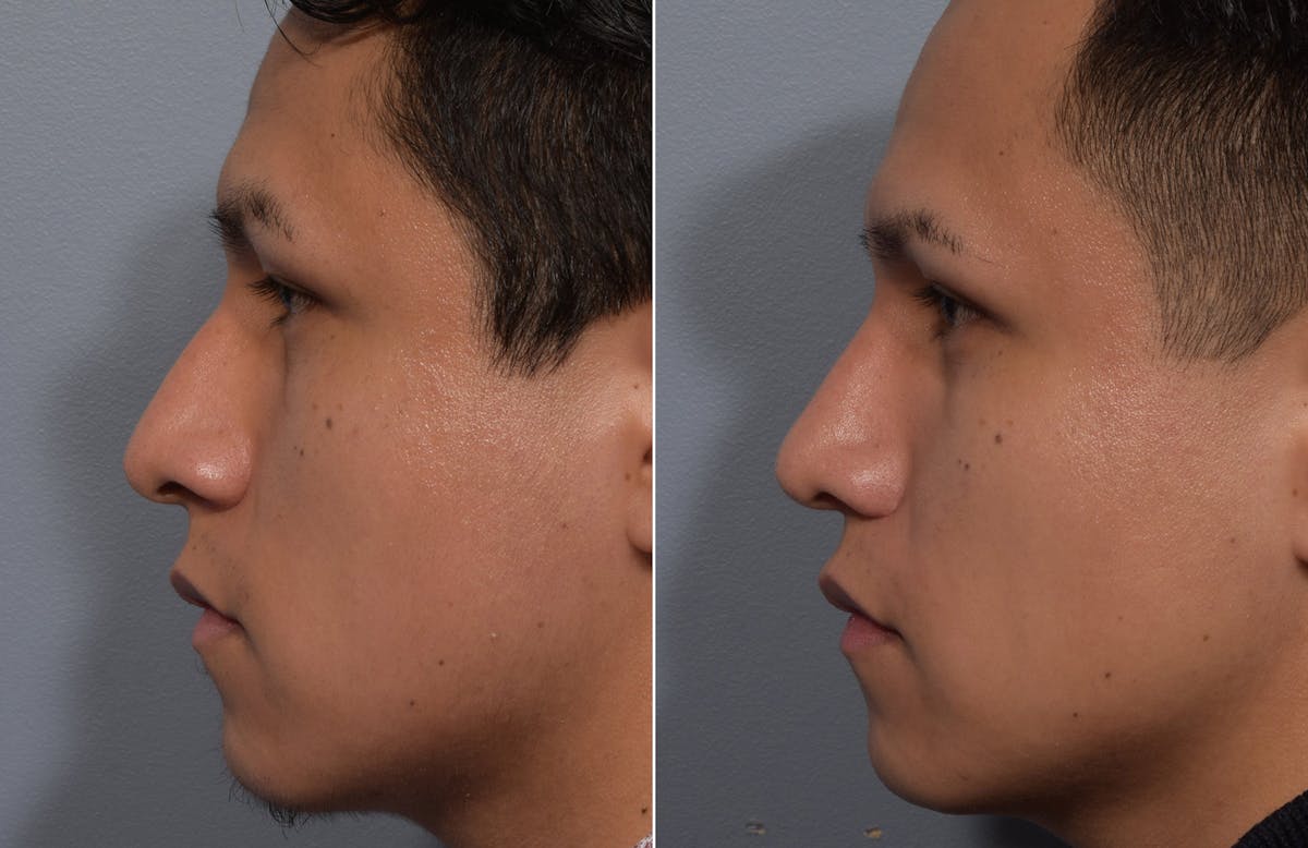 Rhinoplasty Before & After Gallery - Patient 315499 - Image 5