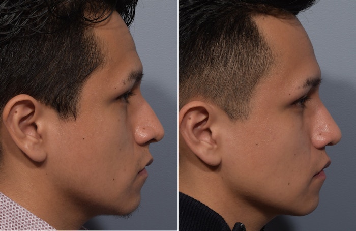 Rhinoplasty Before & After Gallery - Patient 315499 - Image 1