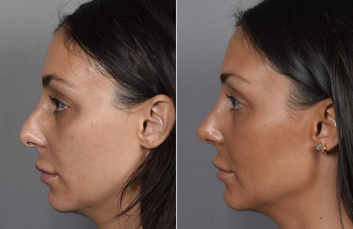 Rhinoplasty Before & After Gallery - Patient 240283 - Image 7