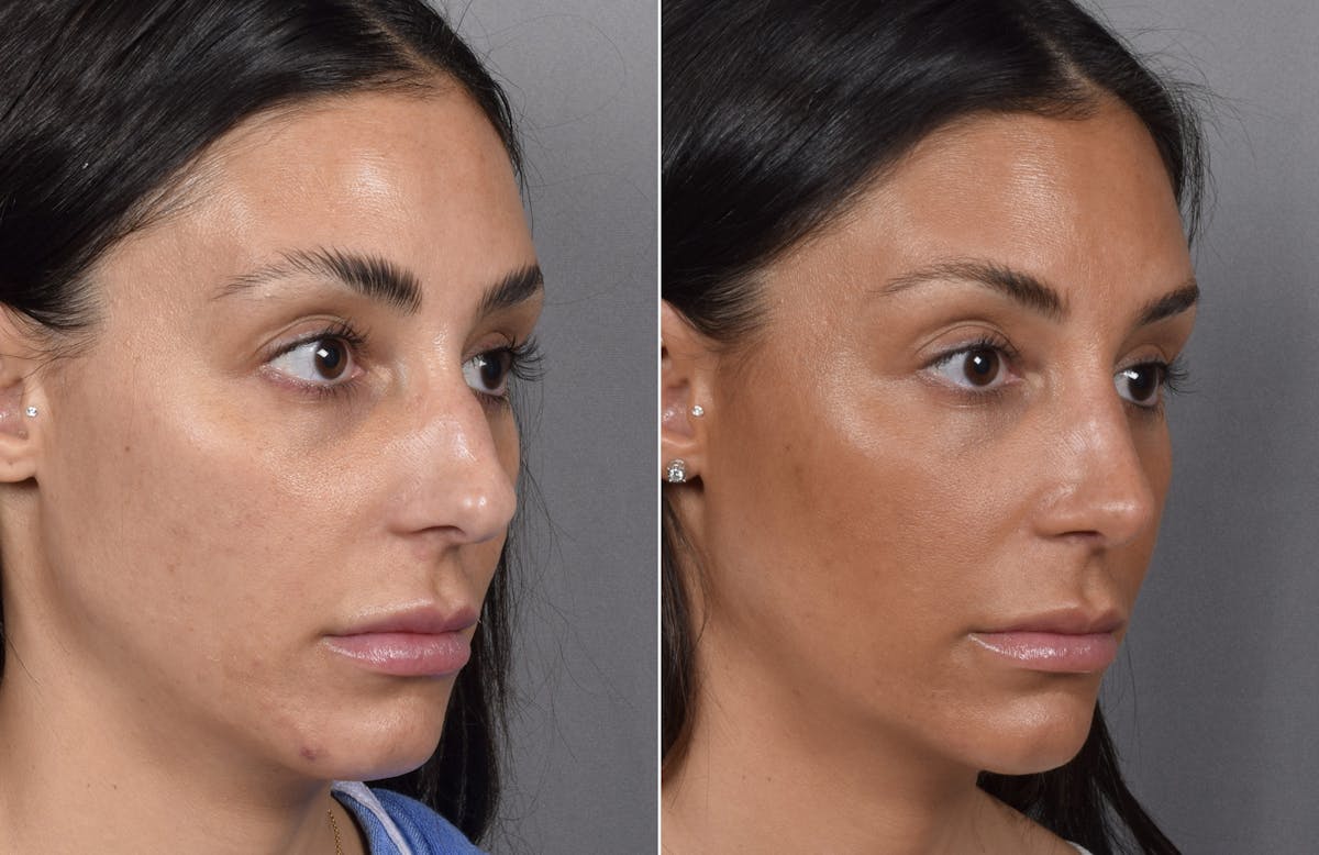 Rhinoplasty Before & After Gallery - Patient 240283 - Image 5