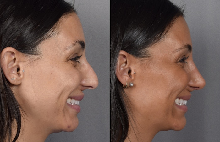 Rhinoplasty Before & After Gallery - Patient 240283 - Image 1
