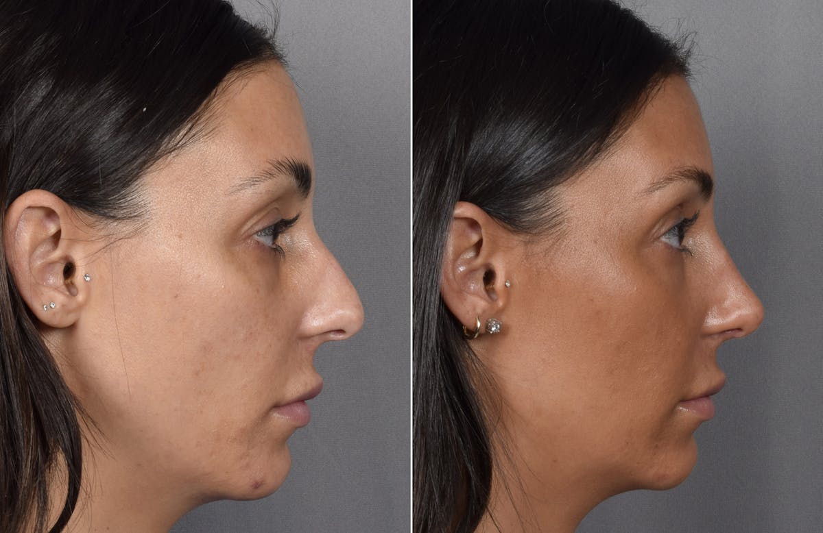 Rhinoplasty Before & After Gallery - Patient 240283 - Image 2