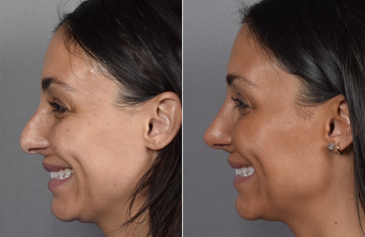Rhinoplasty Before & After Gallery - Patient 240283 - Image 6