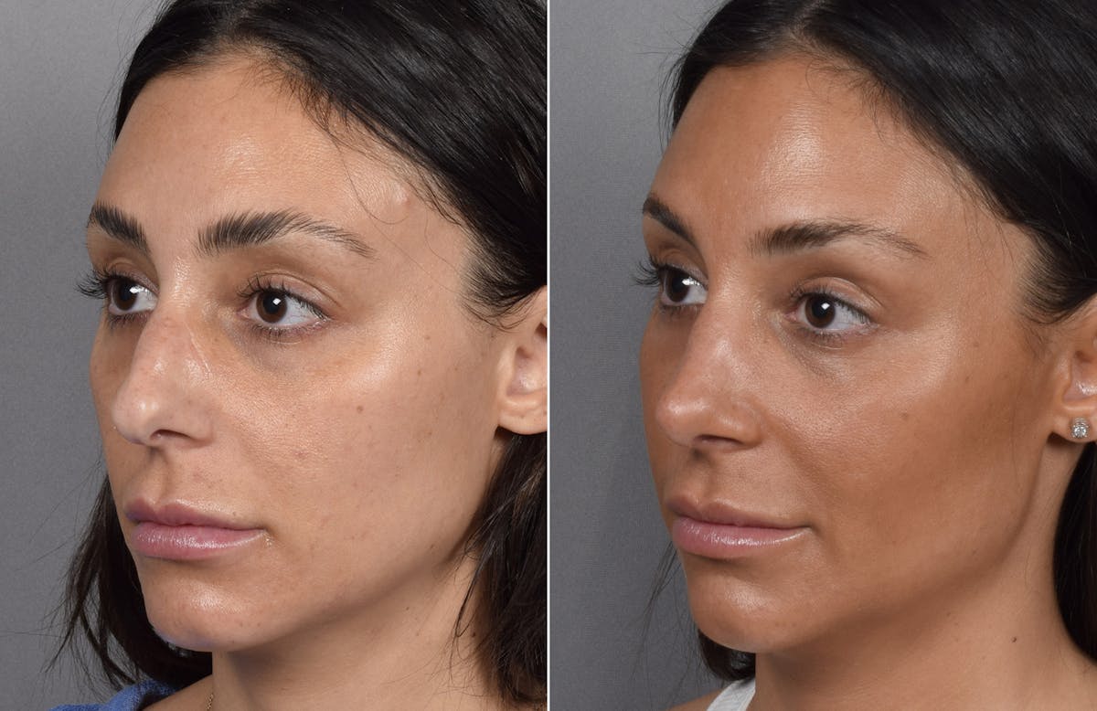 Rhinoplasty Before & After Gallery - Patient 240283 - Image 4