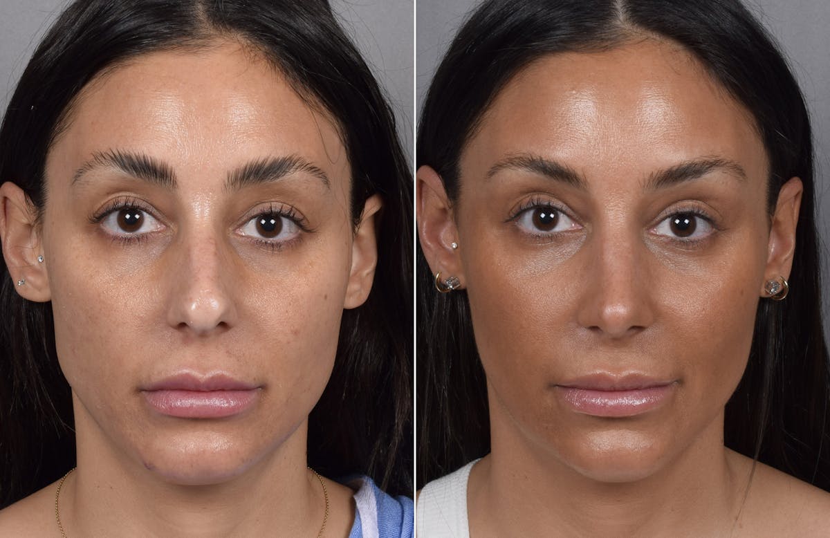 Rhinoplasty Before & After Gallery - Patient 240283 - Image 3