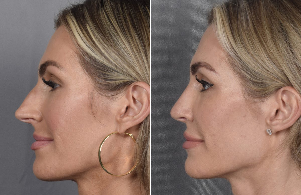 Rhinoplasty Before & After Gallery - Patient 111075 - Image 7