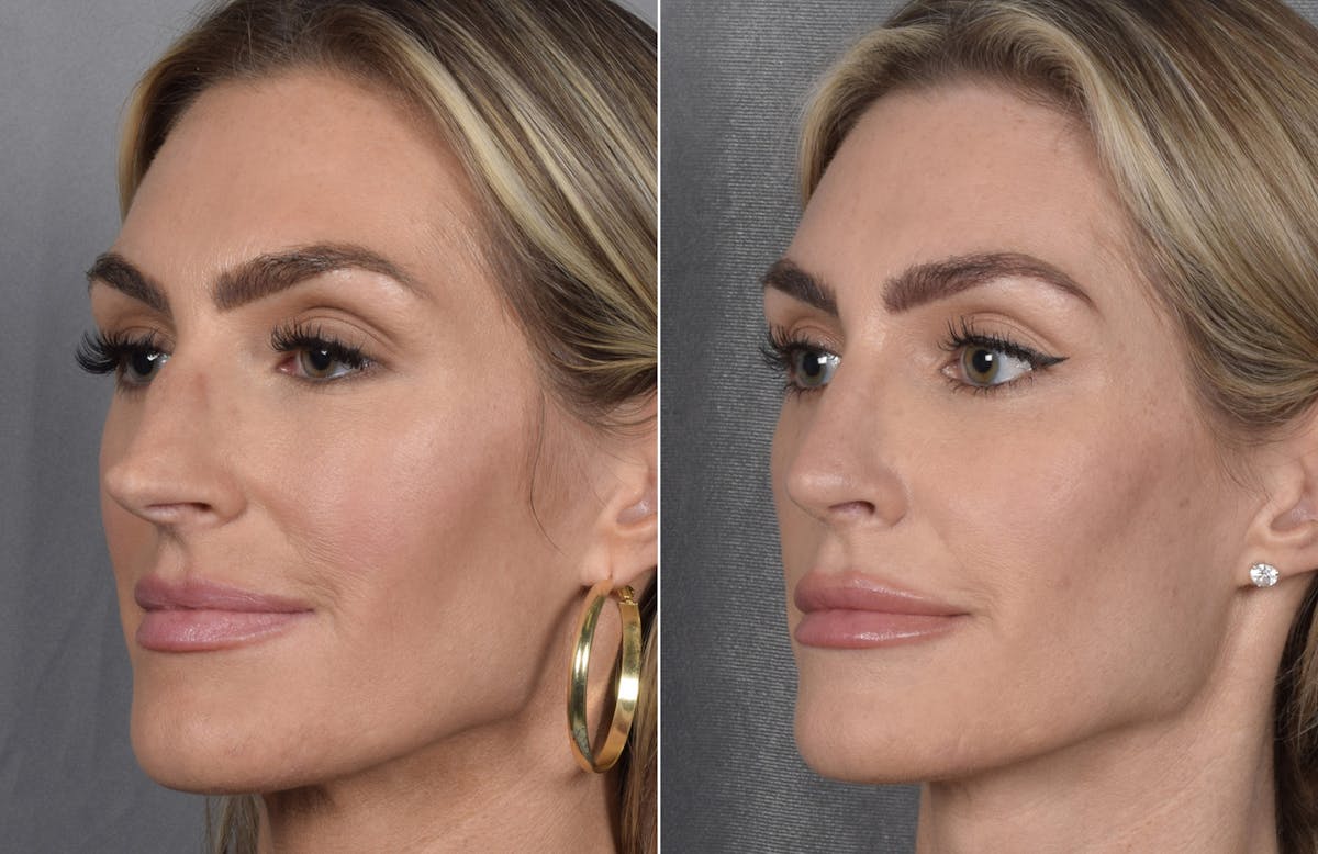 Rhinoplasty Before & After Gallery - Patient 111075 - Image 6