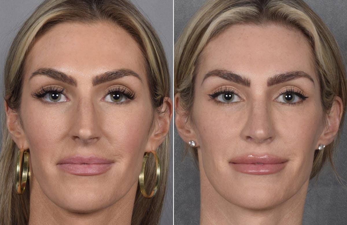 Rhinoplasty Before & After Gallery - Patient 111075 - Image 3
