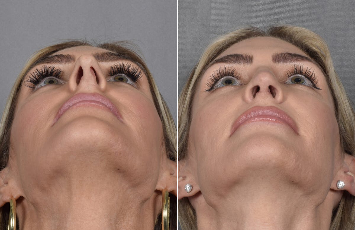Rhinoplasty Before & After Gallery - Patient 111075 - Image 4