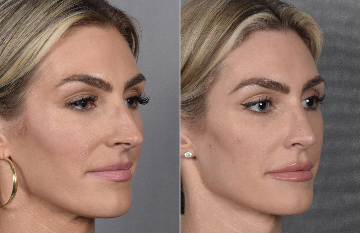 Rhinoplasty Before & After Gallery - Patient 111075 - Image 5