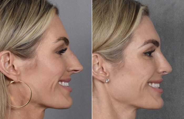 Rhinoplasty Before & After Gallery - Patient 111075 - Image 1