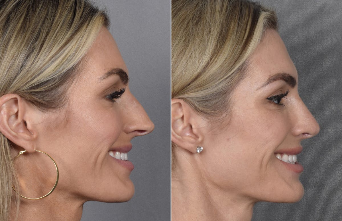 Rhinoplasty Before & After Gallery - Patient 111075 - Image 1