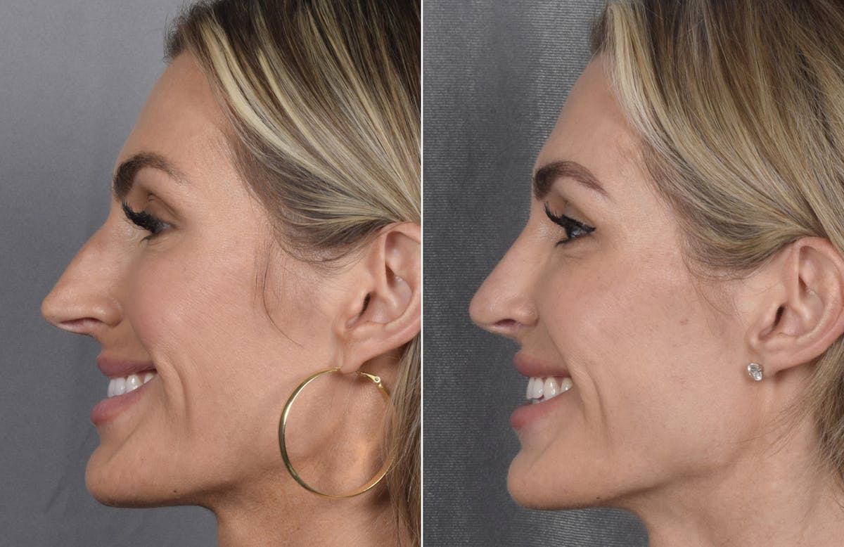 Rhinoplasty Before & After Gallery - Patient 111075 - Image 8