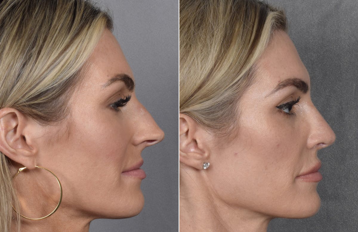 Rhinoplasty Before & After Gallery - Patient 111075 - Image 2
