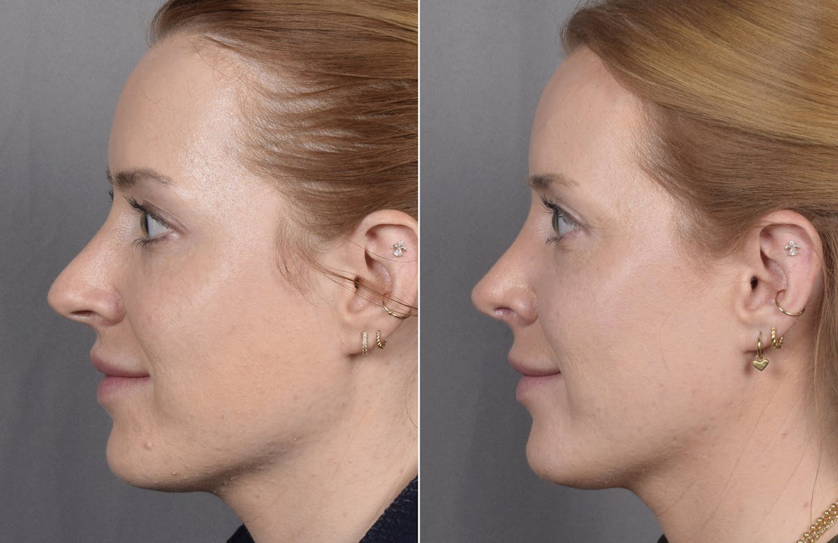Rhinoplasty Before & After Gallery - Patient 322287 - Image 6