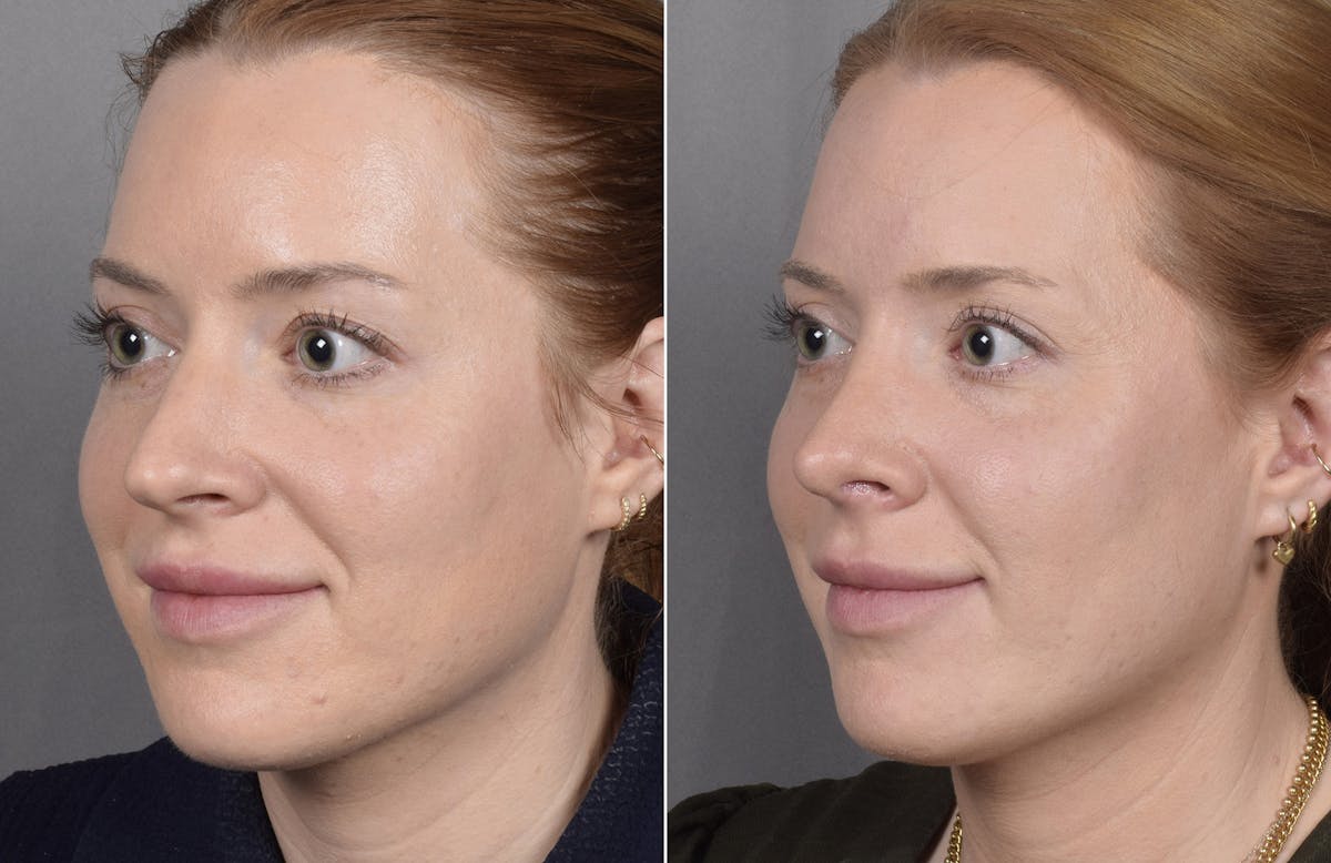 Rhinoplasty Before & After Gallery - Patient 322287 - Image 5