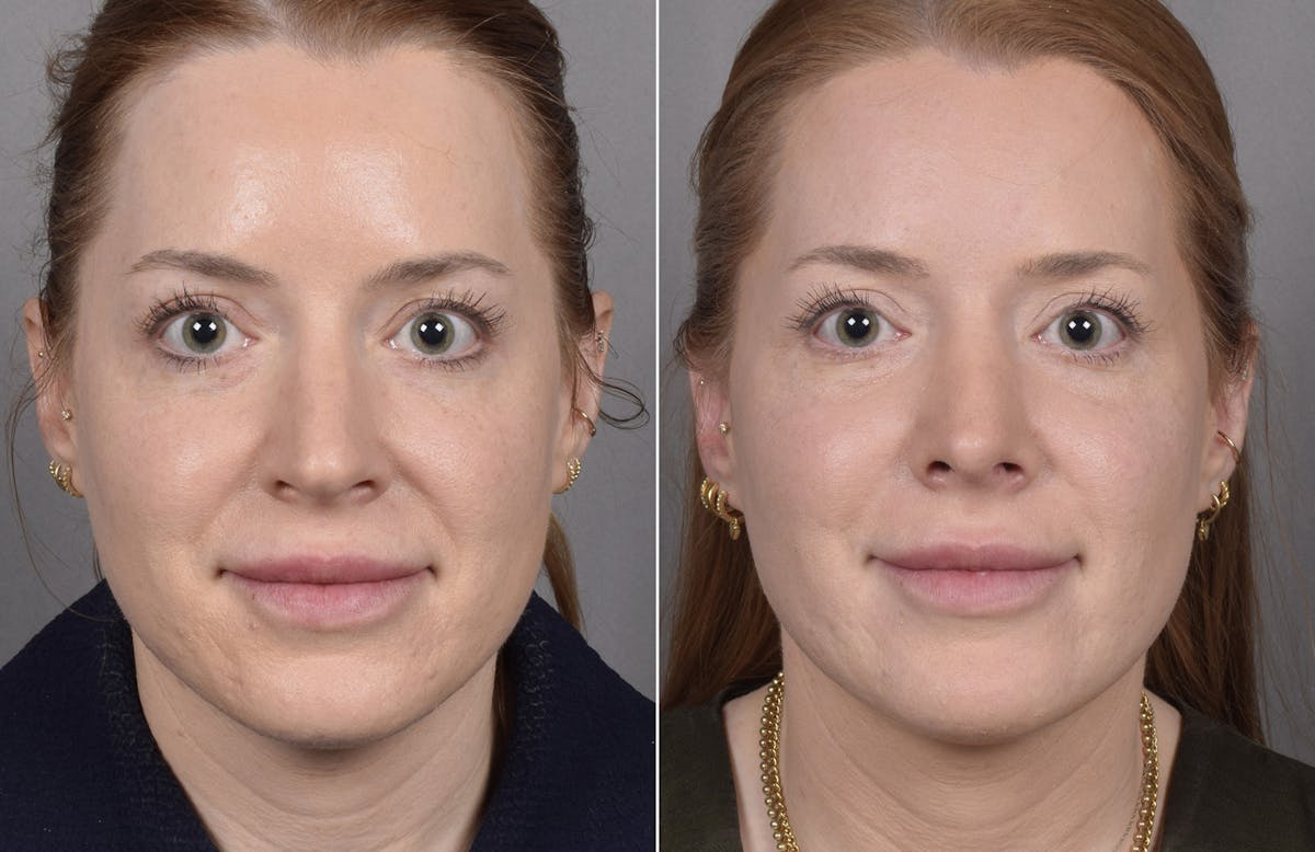 Rhinoplasty Before & After Gallery - Patient 322287 - Image 3