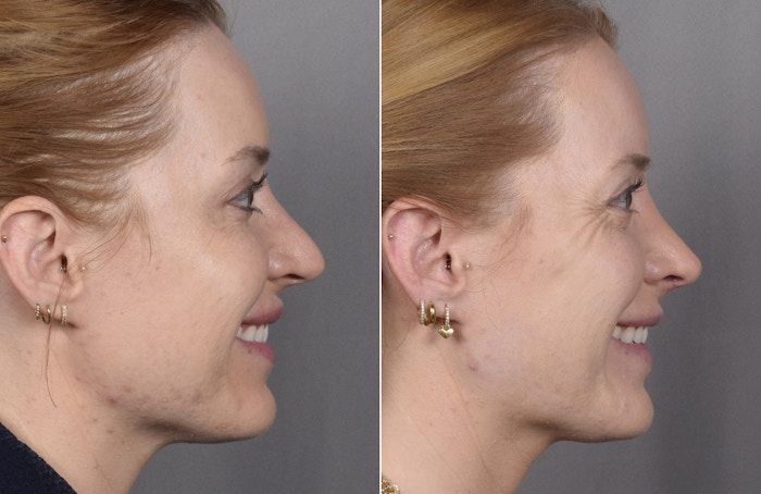 Rhinoplasty Before & After Gallery - Patient 322287 - Image 1