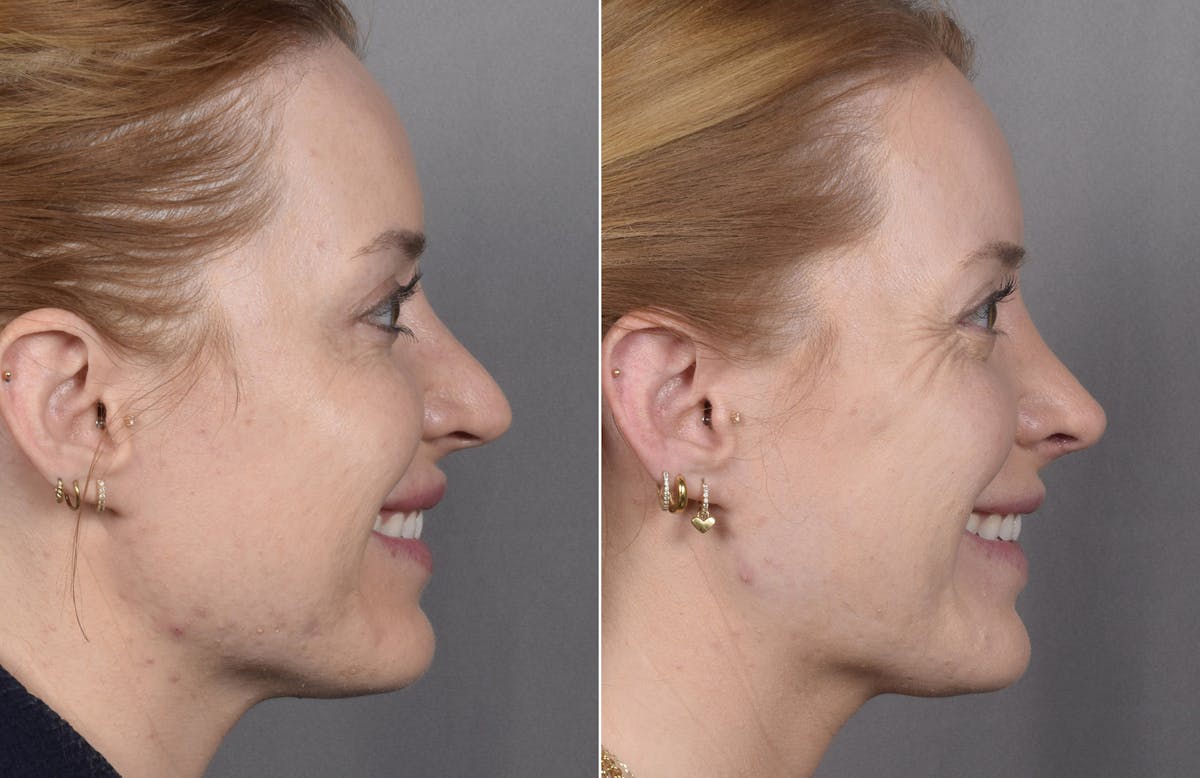 Rhinoplasty Before & After Gallery - Patient 322287 - Image 1
