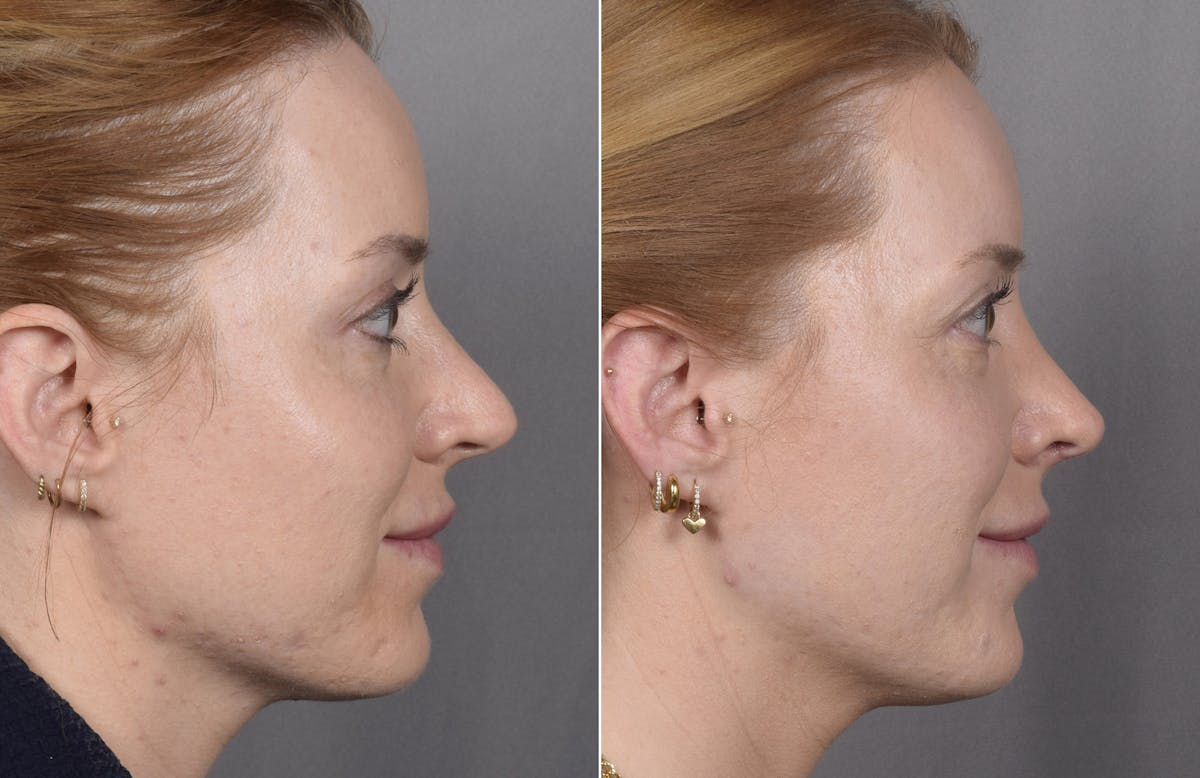 Rhinoplasty Before & After Gallery - Patient 322287 - Image 2
