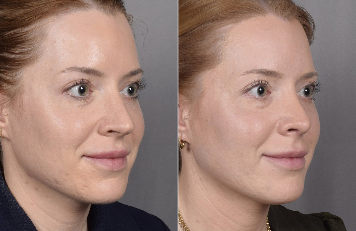 Rhinoplasty Before & After Gallery - Patient 322287 - Image 4