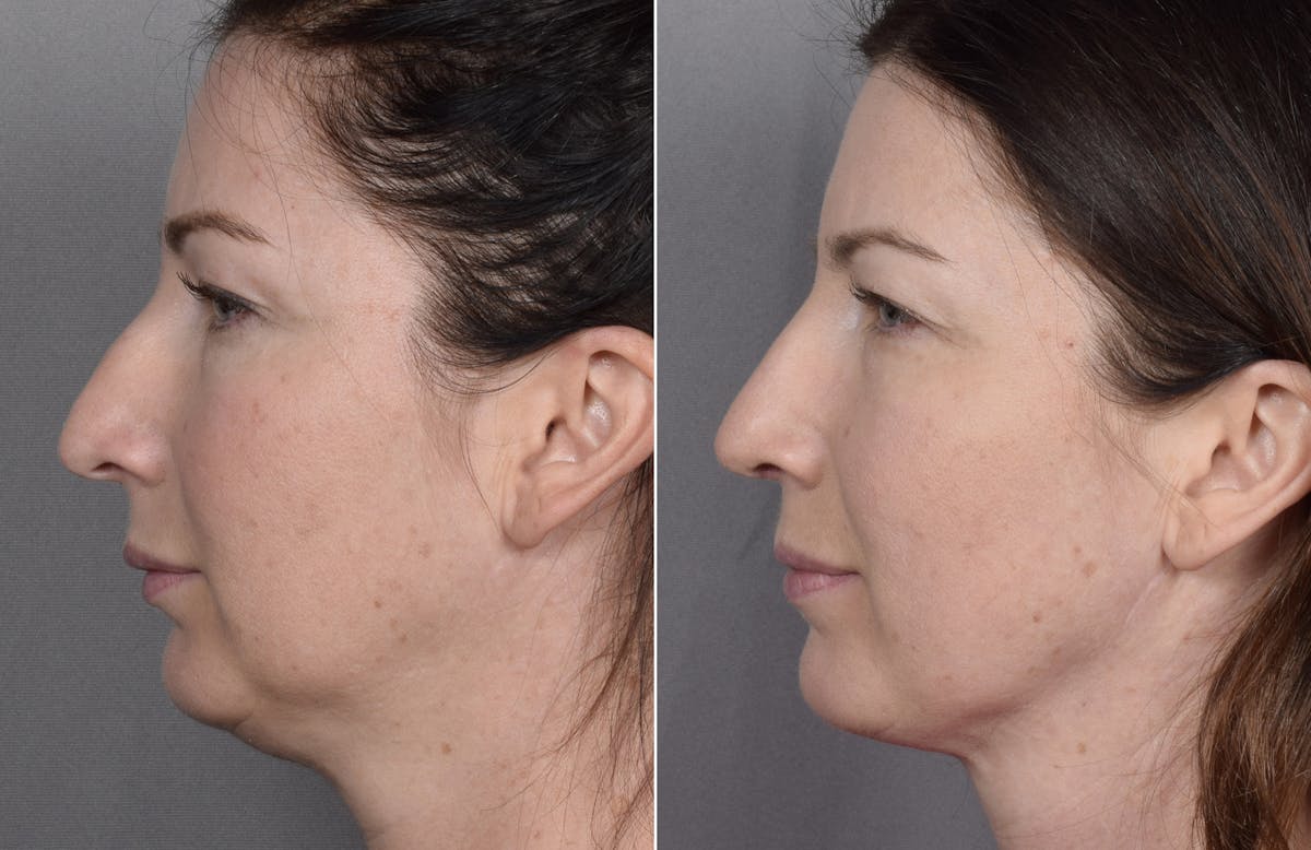 Rhinoplasty Before & After Gallery - Patient 418400 - Image 6