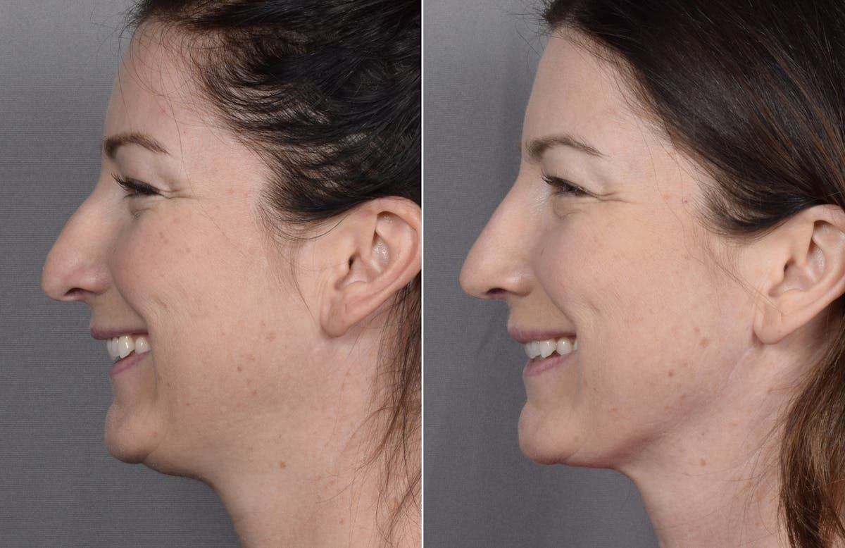 Rhinoplasty Before & After Gallery - Patient 418400 - Image 7
